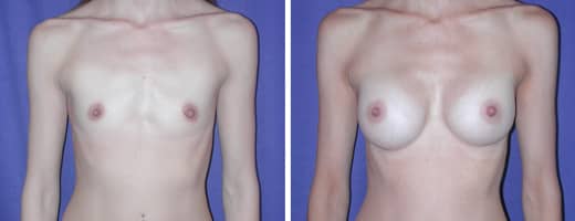 33 years old, 5’9”, 115lbs, 250cc Saline Implants, Preop 32AA to Postop 34B