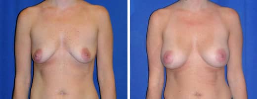 39 years old, 5’8”, 135lbs, 350cc, Silicone Gel Implants, Preop 36B to Postop 36D