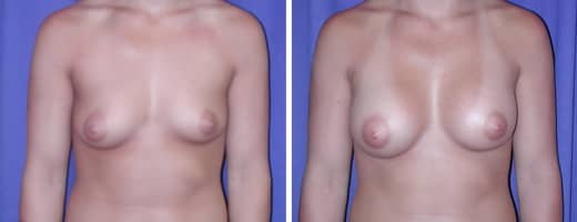 22 years old, 5’9”, 150lbs, 350cc Saline Implants, Preop 36A to Postop 36C