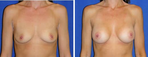 42 years old, 5’9”, 120lbs, 250cc Saline Implants, Preop 36A to Postop 36B