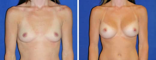 28 years old, 5’0”, 95lbs, 325cc Silicone/Gel Implants, Preop 32A to Postop 32C