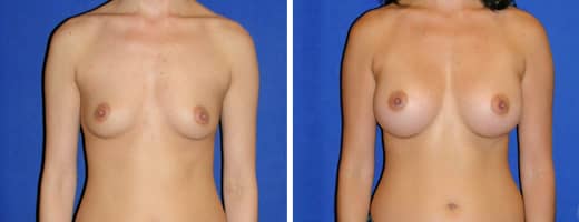 33 years old, 5’5”, 116lbs, 325cc Silicone/Gel Implants, Preop 32B to Postop 32D
