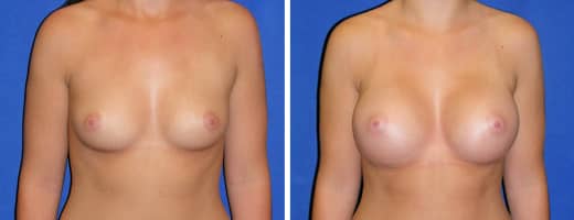 21 years old, 5’3”, 125lbs, 339cc Silicone/Gel Implants, Preop 34A to Postop 34C