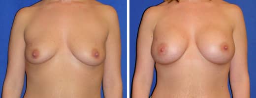 28 years old, 5’5”, 128lbs, 400cc Silicone/Gel Implants, Preop 36B to Postop 36DD