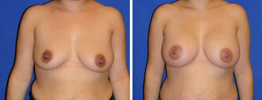 26 years old, 5’3”, 144lbs, 350cc Silicone/Gel Implants, Preop 36C to Postop36D