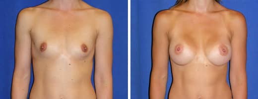 33 years old, 5’3”, 115lbs, 339cc Silicone/Gel Implants, Preop 34A to Postop 34C