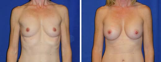 41 years old, 5’4”, 110lbs, 325cc Silicone/Gel Implants, Preop 32AA to Postop 32B