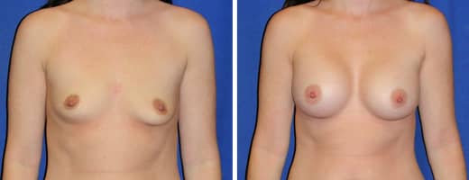 29 years old, 5’4", 129lbs, 325cc Saline Implants, Preop 34A to Postop 34C