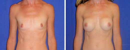 33 years old, 5’6”, 118lbs, 300cc Silicone/Gel Implants, Preop 34AA to Postop 34B