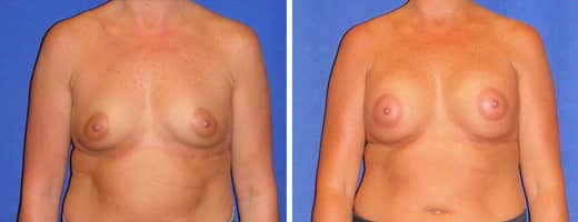 44 years old, 5’6”, 144lbs, 350cc Silicone/Gel Implants, Preop 36B to Postop 36C