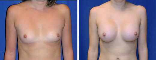 26 years old, 5’5”, 115lbs, 375cc Silicone/Gel Implants, Preop 34B to Postop 32DD