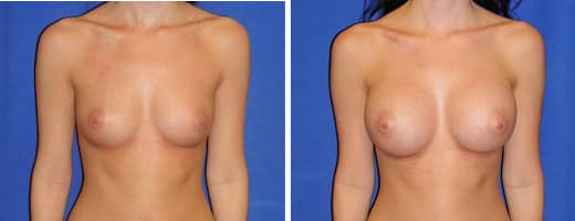 22 years old, 5’4”, 111lbs, 350cc Silicone Gel Implants, Preop 32B to Postop 32D
