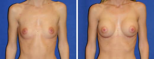 19 years old, 5’6”, 112lbs, 300cc Silicone/Gel Implants, Preop 34B to Postop 34D