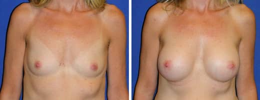 53 years old, 5’3”, 115lbs, 300cc Silicone/Gel Implants, Preop 34B to Postop 34C