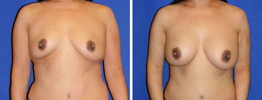 39 years old, 5’2”, 140lbs, 350cc Silicone/Gel Implants, Preop 34B to Postop 34D