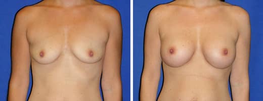 35 years old, 5’5”, 120lbs, 375cc Silicone/Gel Implants, Preop 34A to Postop 34D