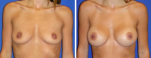 31 years old, 5’5”, 114lbs, 375cc Silicone/Gel Implants, Preop 34B to Postop 34D