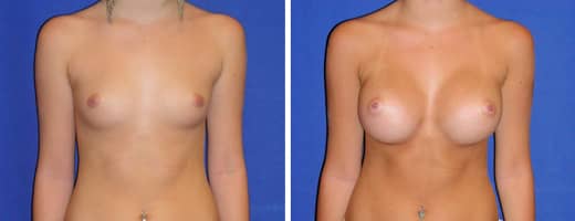 18 years old, 5’7”, 128lbs, 350cc Silicone/Gel Implants, Preop 34A to Postop 34C