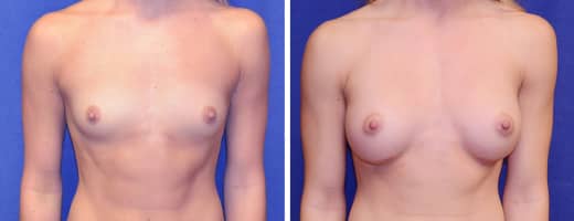 21 years old, 5’2”, 115lbs, 225cc Silicone/Gel Implants, Preop 34A to Postop 34C