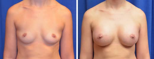 29 years old, 5’7”, 145lbs, 375cc Silicone/Gel Implants, Preop 34A to Postop 34C