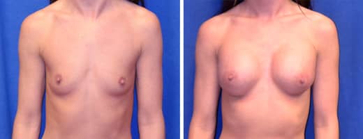 32 years old, 5’5”, 113lbs, 350cc Silicone/Gel Implants, Preop 32A to Postop 32C