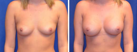 23 years old, 5’2”, 125lbs, 375cc Silicone/Gel Implants, Preop 34B to Postop 34D
