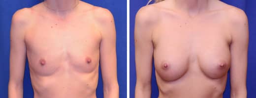 24 years old, 5’6”, 112lbs, 300cc Saline Implants, Preop 32A to Postop 34C