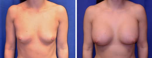 30 years old, 5’3”, 120lbs, 400cc Silicone/Gel Implants, Preop 34B to Postop 34D